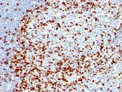 Formalin-fixed, paraffin embedded human tonsil sections stained with 100 ul anti-ZAP70 (clone ZAP70/528 + 2F3.2) at 1:100. HIER epitope retrieval prior to staining was performed in 10mM Tris 1mM EDTA, pH 9.0.